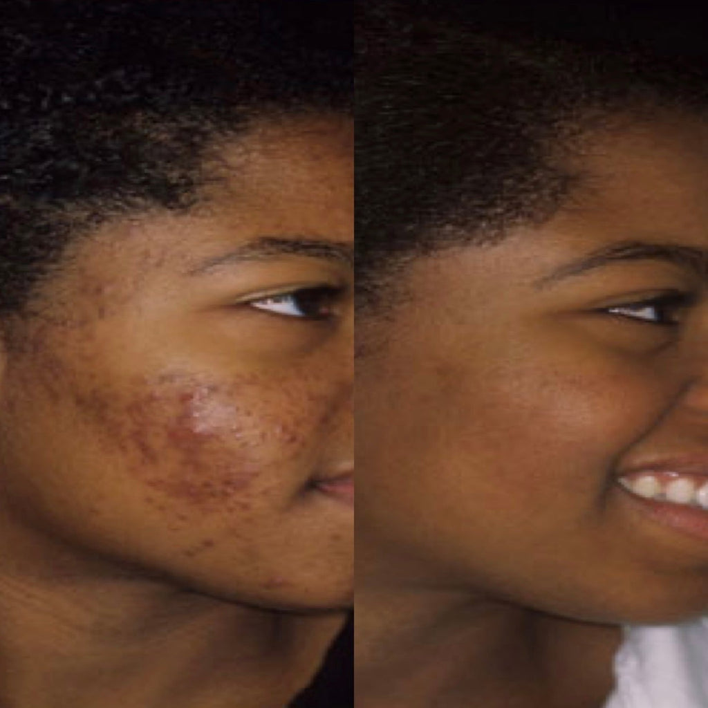 alt="Black girl with before acne pic of right side face and after eight months of using the NU Ammo Acne Bundle."