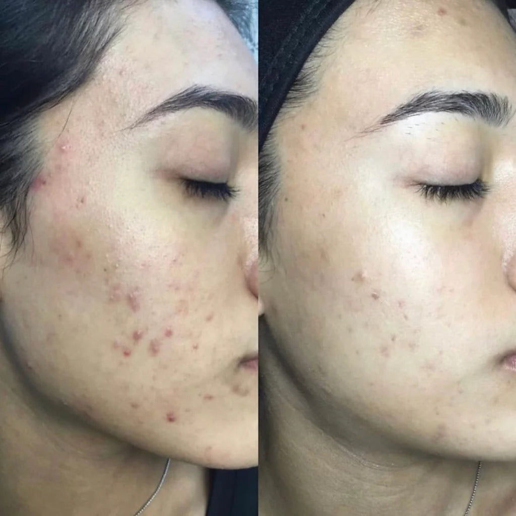 alt="NU Renu Toner before and after 3 months acne picture of hispanic girl right side profile."