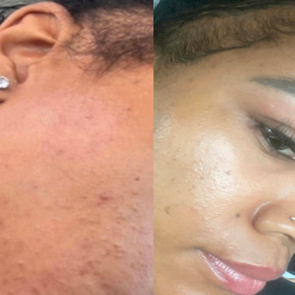 alt="Before and after 4 months pic of black girl with acne on right cheek of face."