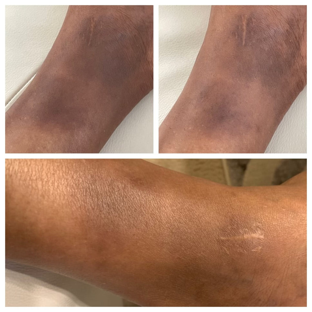 Alt="Before and After of girl with dark spots on ankle before using NU Vanish Dark Spot Combo. Now has clear skin"