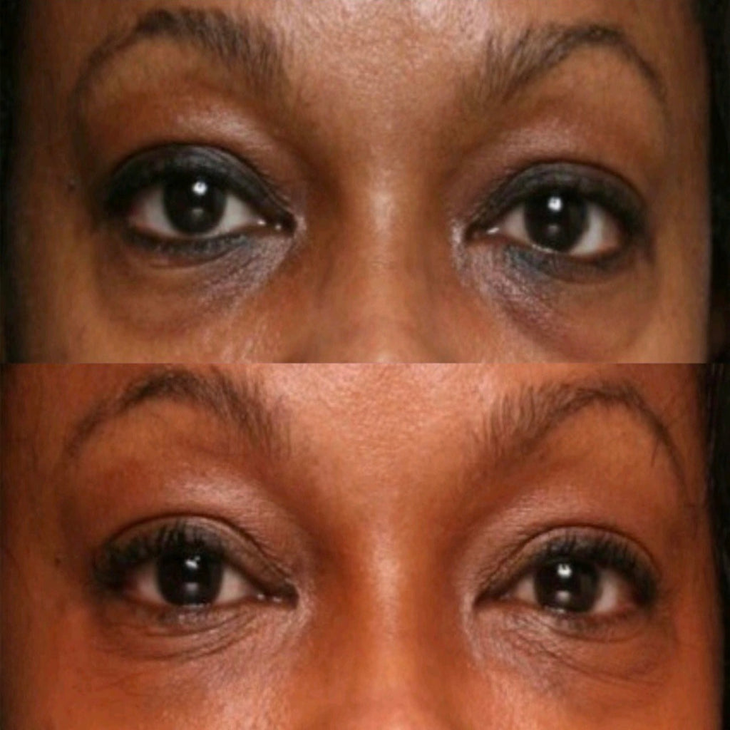 before and after picture of a black woman with dark circles around her eyes and cleared after use of active eye cream.